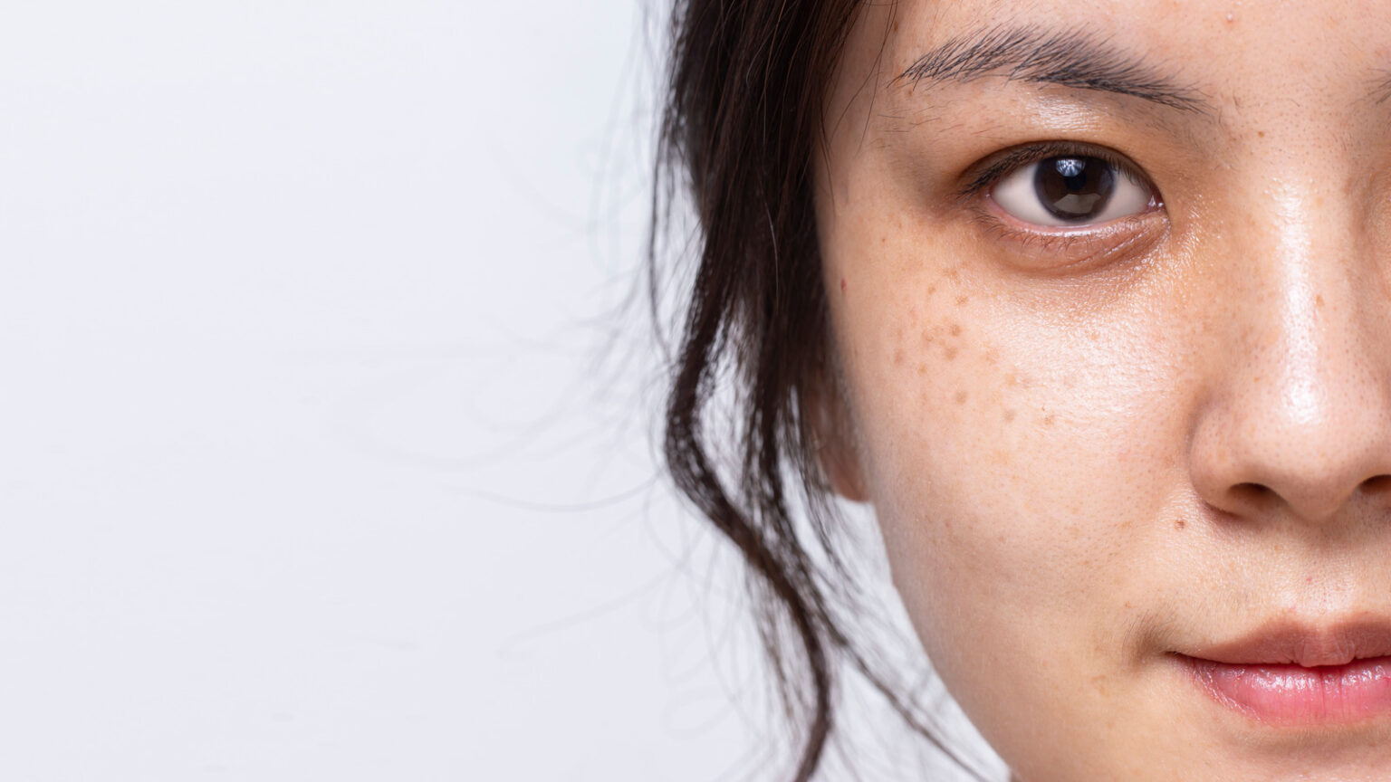 A Freckle and a Birthmark Are Examples of Unique Skin Marks