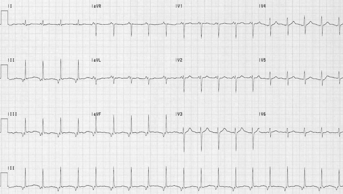 accelerated junctional rhythm key examples 1