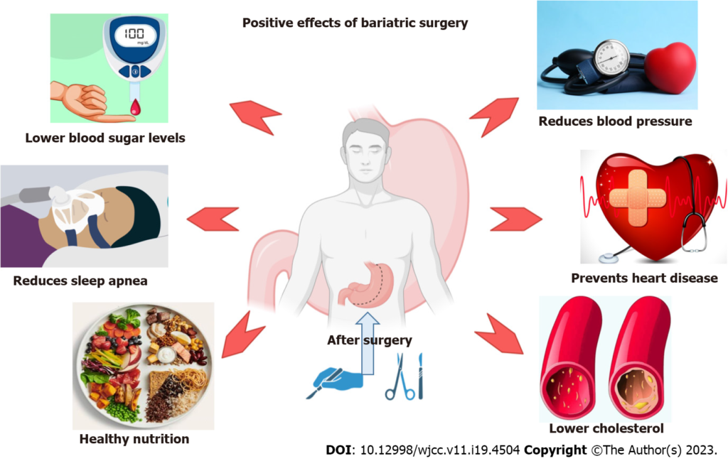 bariatric surgery risks key examples to know