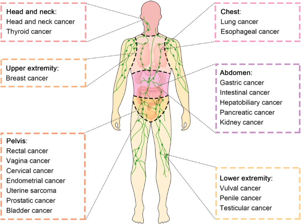 cancer lymph nodes in neck key insights