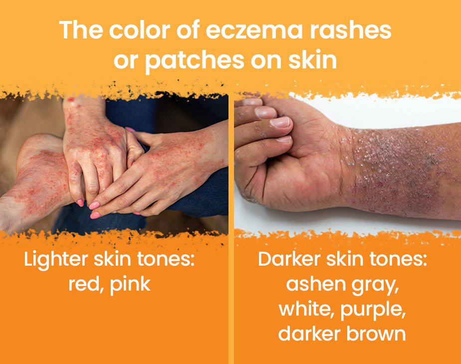 different eczema types key examples explained