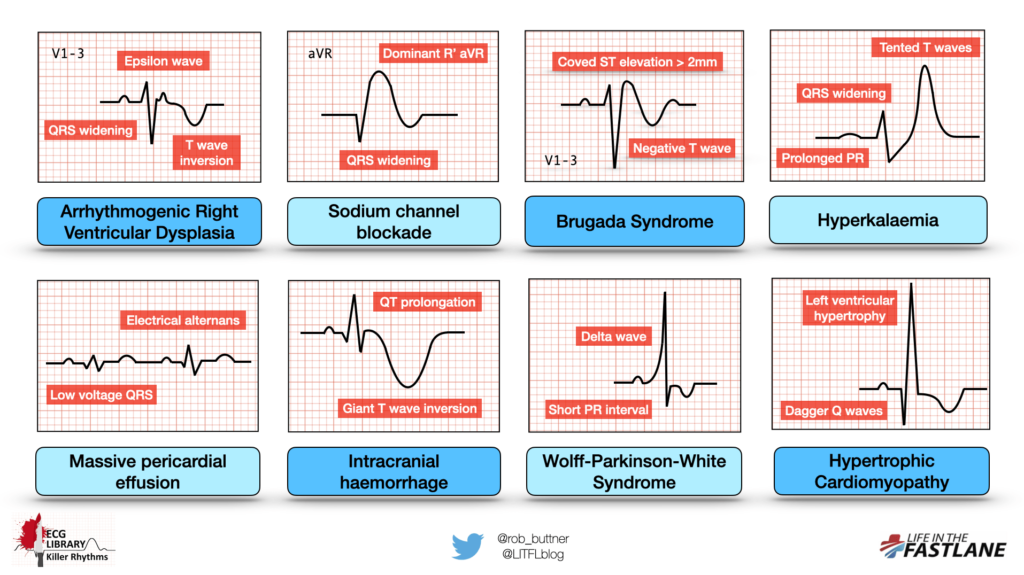 ekg examples and insights for heart health