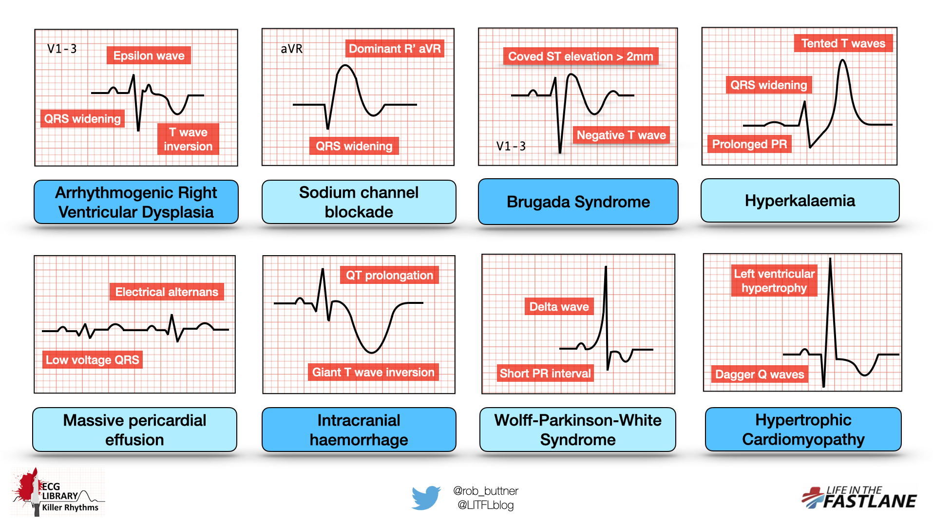 ekg examples and insights for heart health