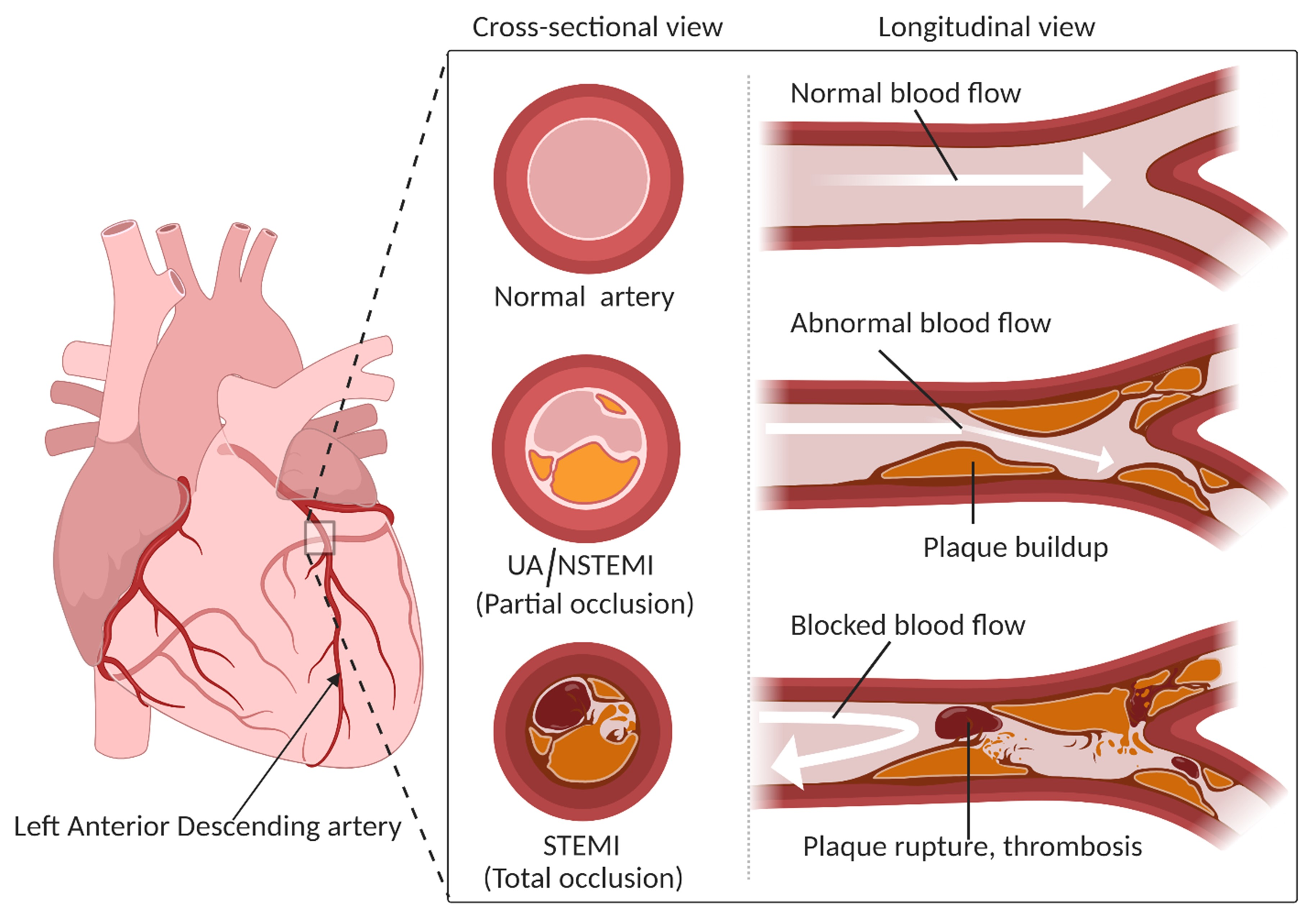 examples of acute coronary syndromes acs explained