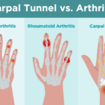 examples of carpal tunnel syndrome tendonitis and back pain