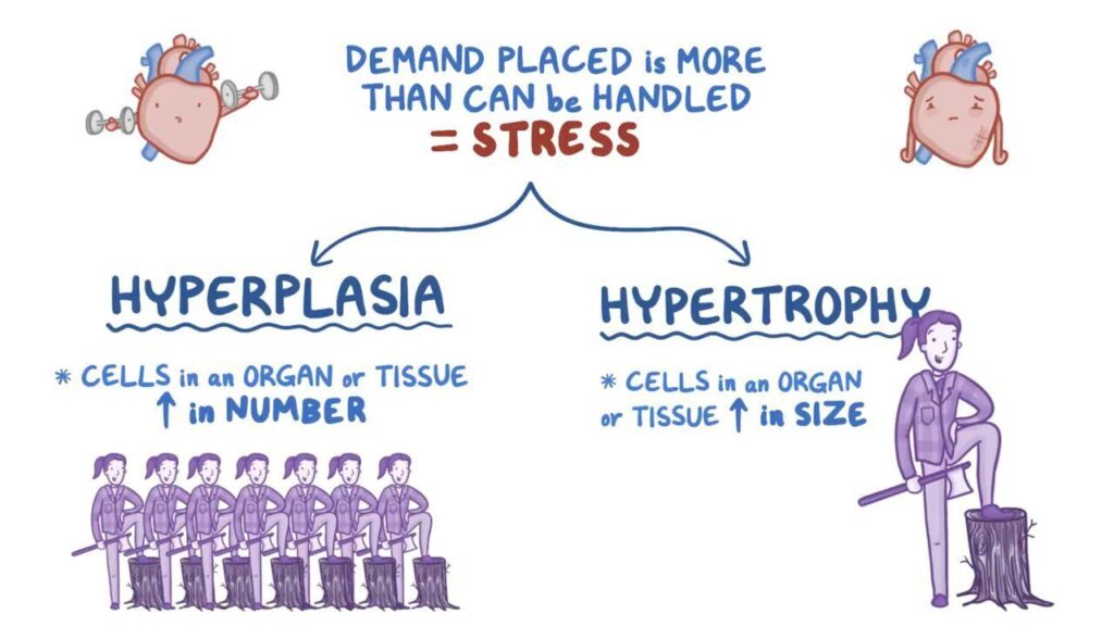 examples of hyperplasia in the human body