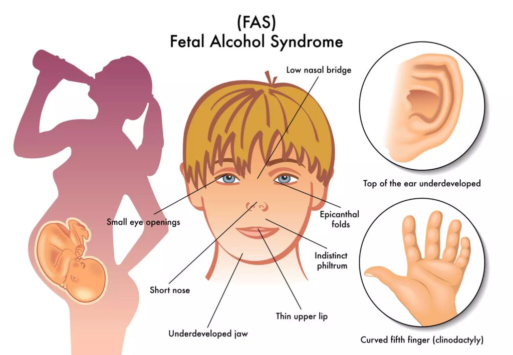 fetal alcohol syndrome symptoms to recognize early