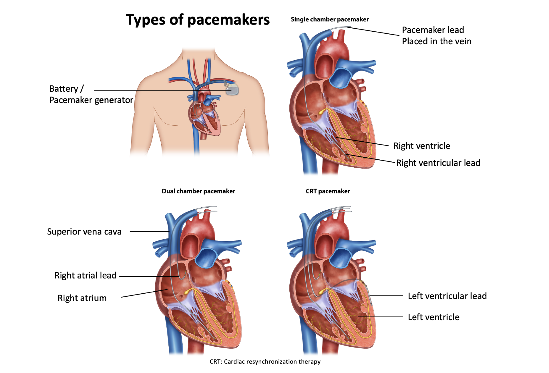 heart valves and pacemakers are examples of cardiac devices