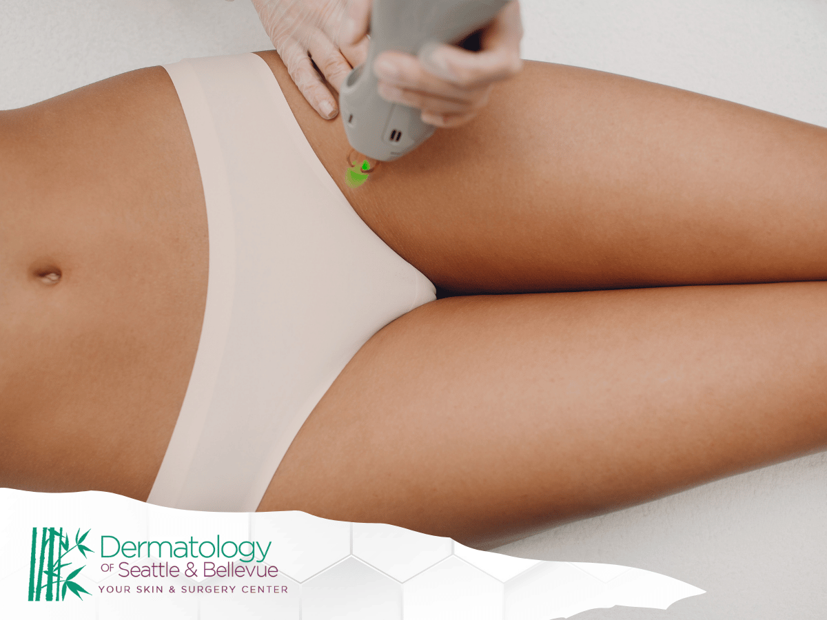 permanent hair removal exceptions explained