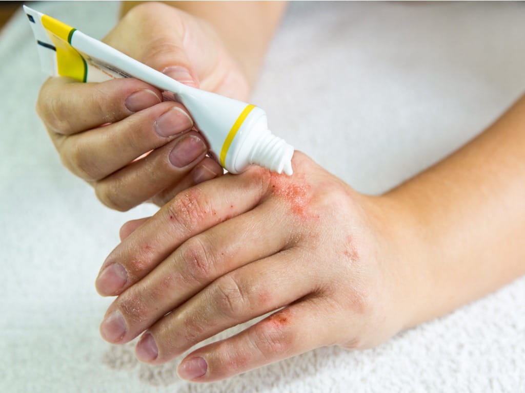 uses of hidrocortisona for skin and health issues