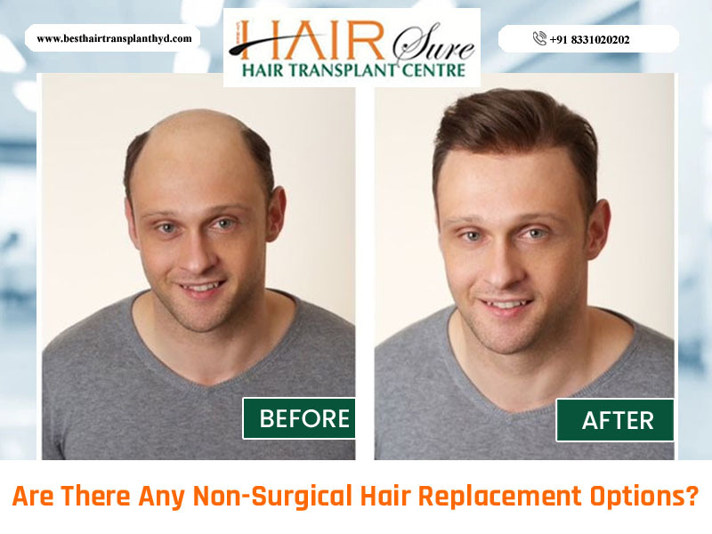 which options arent non surgical hair loss solutions
